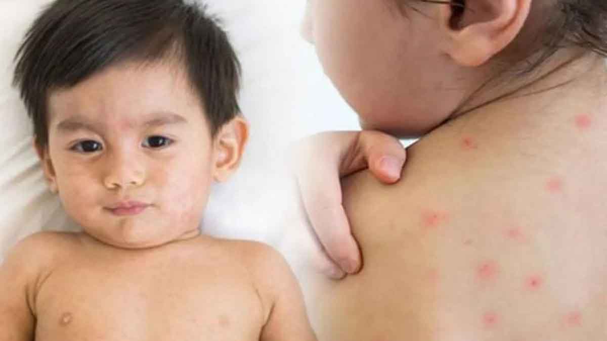 হাম হলে দ্রুত সুস্থতা পেতে যে ৫টি পানীয় খাবেন