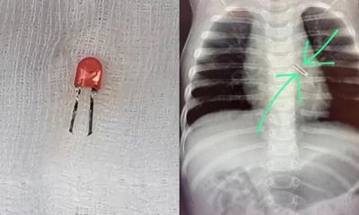 শিশুর ফুসফুস থেকে বের করা হলো এলইডি বাল্ব