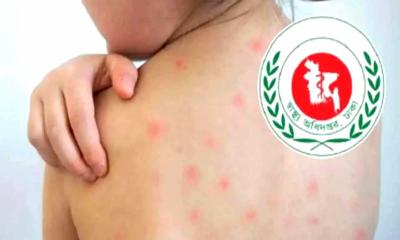 হামের উপসর্গে আরও ৬ জনের মৃত্যু