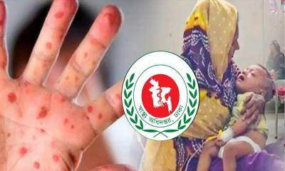 হাম ও হামের উপসর্গে এ পর্যন্ত মারা গেল ৫৮৫ শিশু