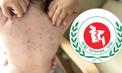 দেশে হাম ও উপসর্গে আরও ৭ শিশুর মৃ`ত্যু