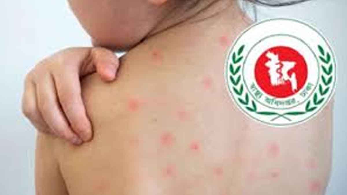 দেশে হামে আরও ৫ শিশুর মৃত্যু, নতুন আক্রান্ত ১২৭৮