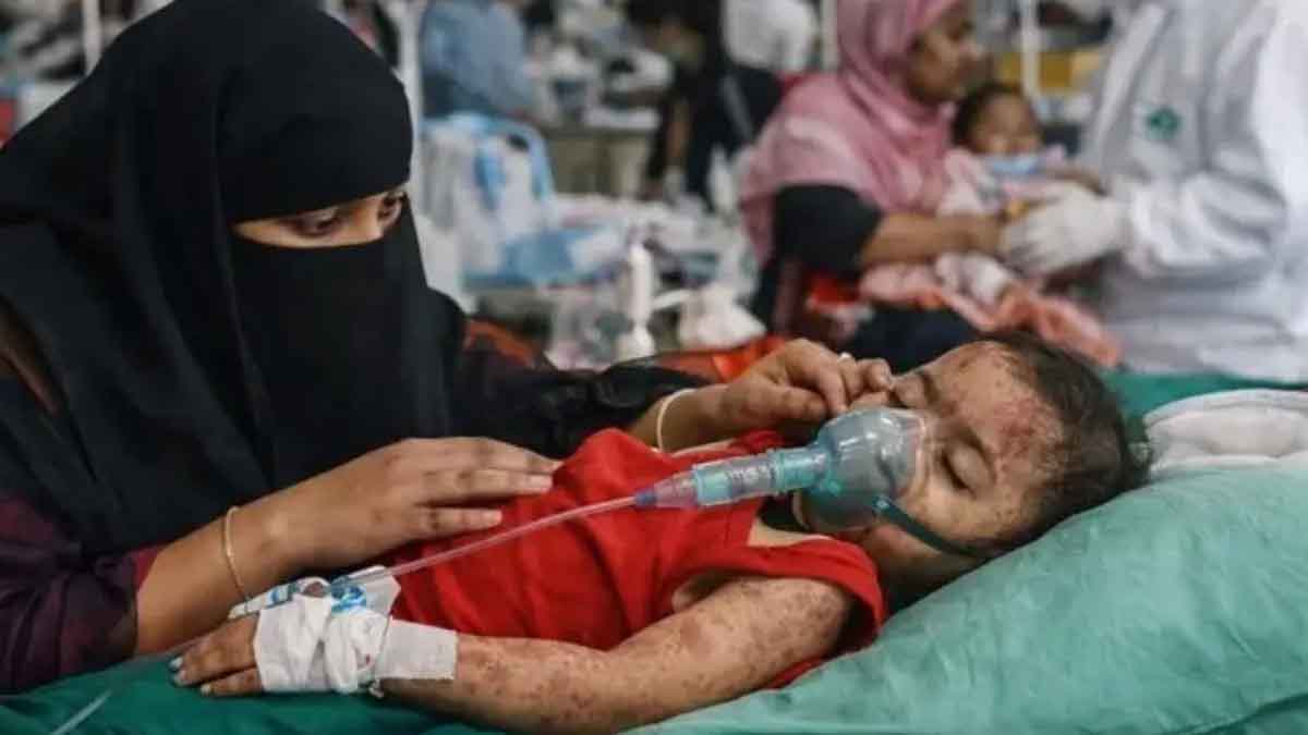 হামের উপসর্গে আরও ১৬ জনের মৃত্যু