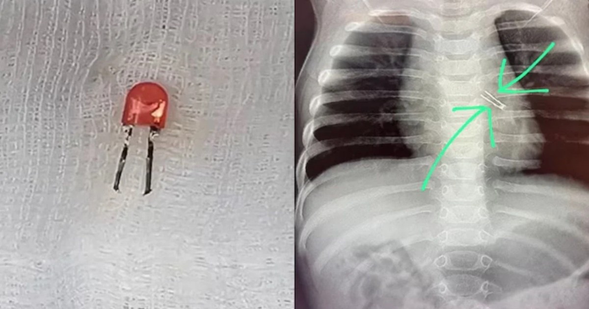 শিশুর ফুসফুস থেকে বের করা হলো এলইডি বাল্ব