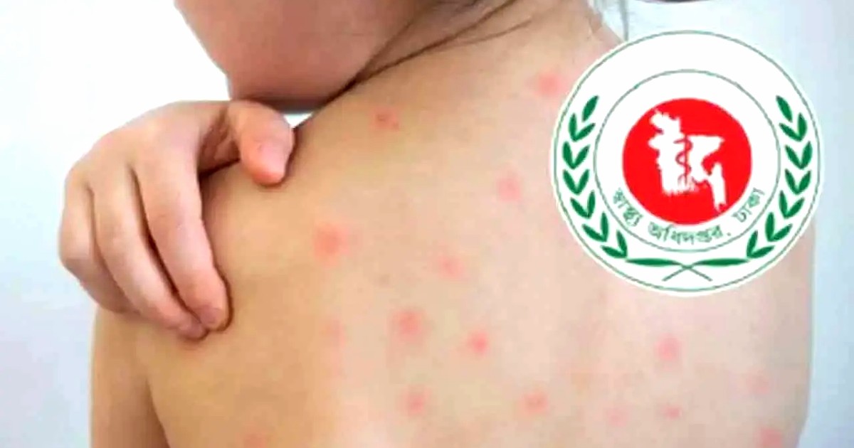 হামের উপসর্গে আরও ৬ জনের মৃত্যু