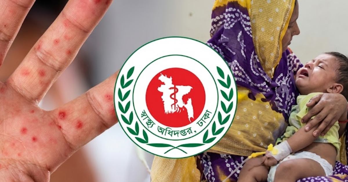 হামের উপসর্গে ২৪ ঘণ্টায় আরও ৮ শিশুর মৃত্যু