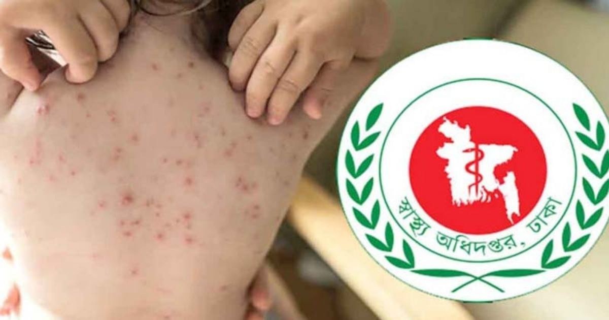 বাংলাদেশে হামের প্রাদুর্ভাব উচ্চ ঝুঁকির সতর্কতা ডব্লিউএইচও-র