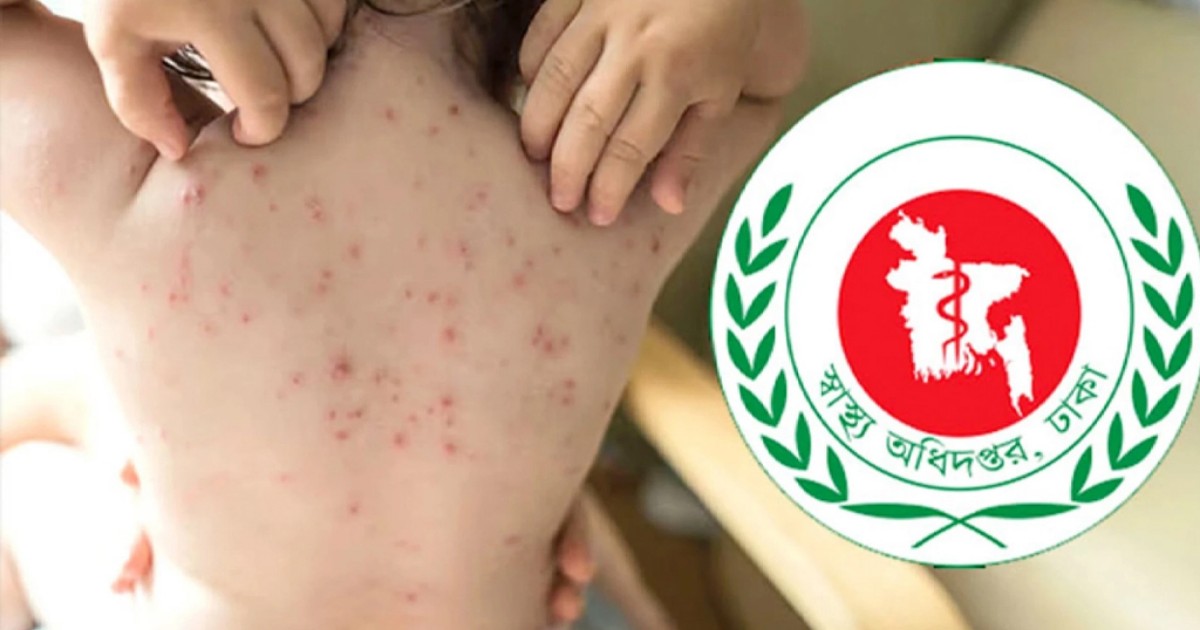 ২৪ ঘণ্টায় হাম উপসর্গে আরও ১১ শিশুর মৃ‍‍`ত্যু