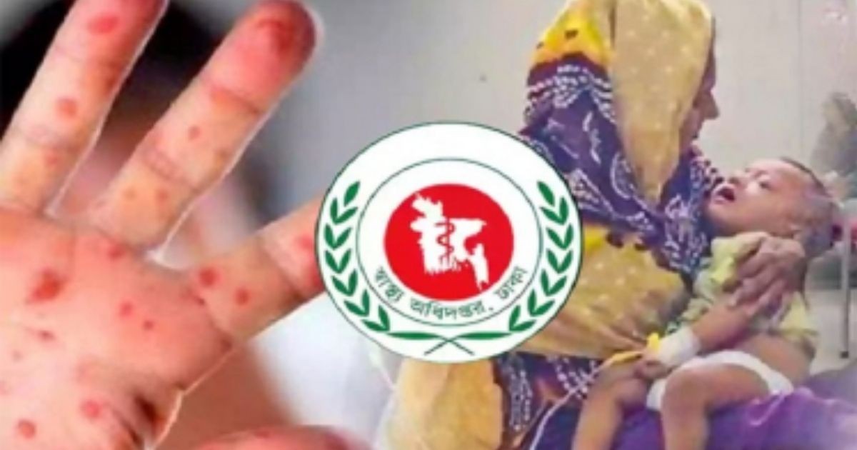 দেশে হামের ভয়াবহতা বাড়ছে, মৃত্যু বেড়ে দাঁড়িয়েছে ৪০৯ জনে