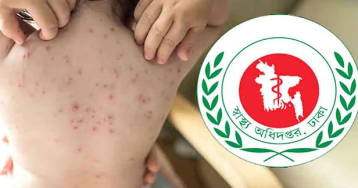 দেশে গত ২৪ ঘণ্টায় হামে আরও ৬ জনের মৃত্যু