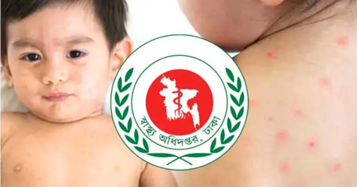 ২৪ ঘণ্টায় হাম ও উপসর্গে প্রাণ হারাল ৭ শিশু