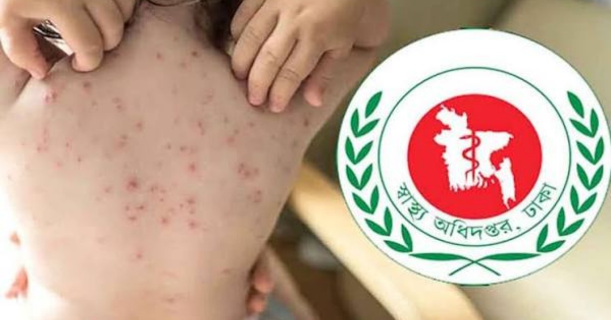 হামের প্রকোপ: ২৪ ঘণ্টায় আরও ৪ শিশুর মৃত্যু
