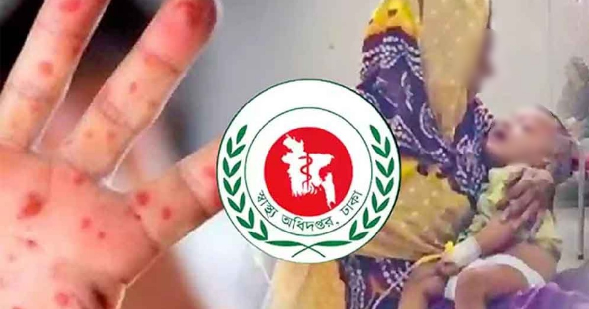দেশে হামের প্রকোপ আরও বাড়ল, ২৪ ঘণ্টায় ৫ শিশুর মৃত্যু