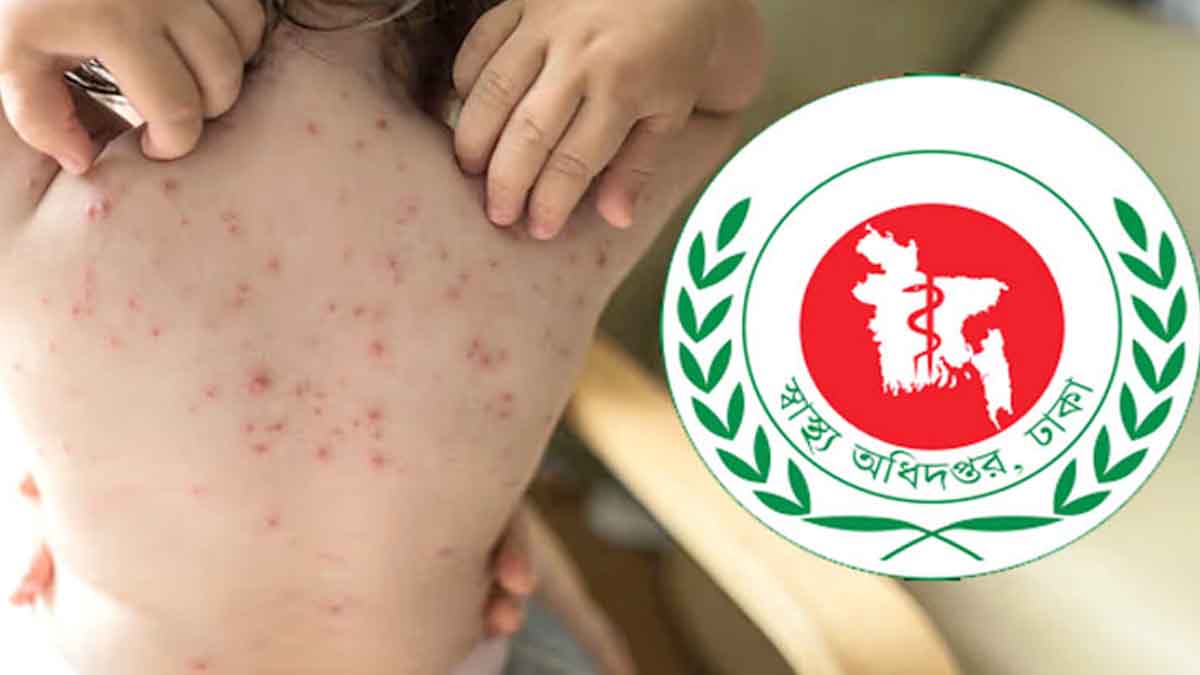 গত ২৪ ঘণ্টায় হামের উপসর্গ নিয়ে আরও ৭ জনের মৃ‍‍`ত্যু